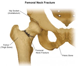 femoral neck fracture